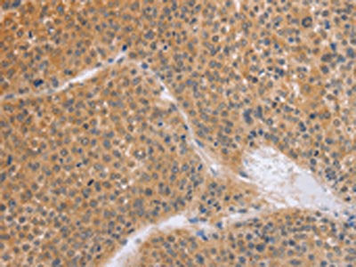 The image on the left is immunohistochemistry of paraffin-embedded Human liver cancer tissue using CSB-PA439979(BRS3 Antibody) at dilution 1/50, on the right is treated with synthetic peptide. (Original magnification: ×200)