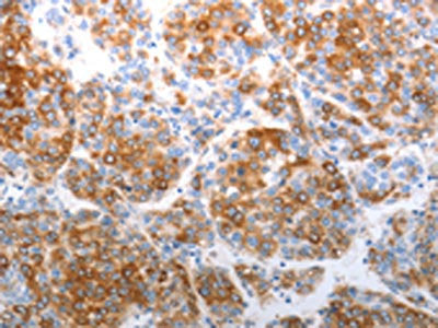 The image on the left is immunohistochemistry of paraffin-embedded Human liver cancer tissue using CSB-PA440133(CDH5 Antibody) at dilution 1/40, on the right is treated with synthetic peptide. (Original magnification: ×200)