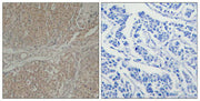 Immunohistochemical analysis of paraffin-embedded human breast carcinoma tissue using Smad3(Ab-208) Antibody(left) or the same antibody preincubated with blocking peptide(right).