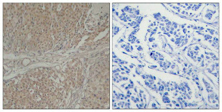 Immunohistochemical analysis of paraffin-embedded human breast carcinoma tissue using Smad3(Ab-208) Antibody(left) or the same antibody preincubated with blocking peptide(right).