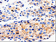 The image on the left is immunohistochemistry of paraffin-embedded Human liver cancer tissue using CSB-PA440339(ABCG2 Antibody) at dilution 1/50, on the right is treated with synthetic peptide. (Original magnification: ×200)
