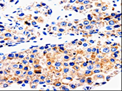 The image on the left is immunohistochemistry of paraffin-embedded Human liver cancer tissue using CSB-PA440339(ABCG2 Antibody) at dilution 1/50, on the right is treated with synthetic peptide. (Original magnification: ×200)