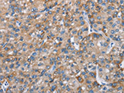 The image on the left is immunohistochemistry of paraffin-embedded Human liver cancer tissue using CSB-PA440550(CHDH Antibody) at dilution 1/25, on the right is treated with fusion protein. (Original magnification: ×200)