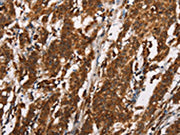 The image on the left is immunohistochemistry of paraffin-embedded Human gastic cancer tissue using CSB-PA440750(CTAG1A/B Antibody) at dilution 1/25, on the right is treated with synthetic peptide. (Original magnification: ×200)
