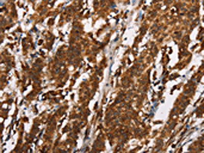 The image on the left is immunohistochemistry of paraffin-embedded Human gastic cancer tissue using CSB-PA440750(CTAG1A/B Antibody) at dilution 1/25, on the right is treated with synthetic peptide. (Original magnification: ×200)