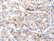 The image on the left is immunohistochemistry of paraffin-embedded Human lung cancer tissue using CSB-PA440881(CDK7 Antibody) at dilution 1/30, on the right is treated with fusion protein. (Original magnification: X200)