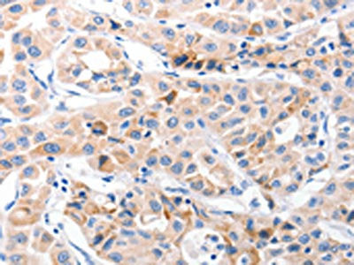 The image on the left is immunohistochemistry of paraffin-embedded Human lung cancer tissue using CSB-PA440881(CDK7 Antibody) at dilution 1/30, on the right is treated with fusion protein. (Original magnification: X200)