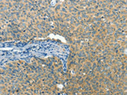 The image on the left is immunohistochemistry of paraffin-embedded Human cervical cancer tissue using CSB-PA440945(BCAT1 Antibody) at dilution 1/50, on the right is treated with fusion protein. (Original magnification: ×200)