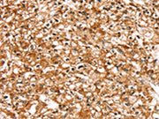The image on the left is immunohistochemistry of paraffin-embedded Human prostate cancer tissue using CSB-PA441309(SLC16A12 Antibody) at dilution 1/30, on the right is treated with synthetic peptide. (Original magnification: ×200)