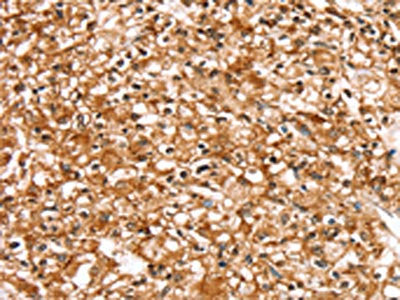 The image on the left is immunohistochemistry of paraffin-embedded Human prostate cancer tissue using CSB-PA441309(SLC16A12 Antibody) at dilution 1/30, on the right is treated with synthetic peptide. (Original magnification: ×200)
