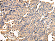 The image on the left is immunohistochemistry of paraffin-embedded Human prostate cancer tissue using CSB-PA441389(SDCBP Antibody) at dilution 1/40, on the right is treated with fusion protein. (Original magnification: ×200)