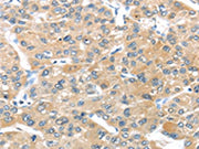 The image on the left is immunohistochemistry of paraffin-embedded Human liver cancer tissue using CSB-PA441556(UCP3 Antibody) at dilution 1/20, on the right is treated with synthetic peptide. (Original magnification: ×200)