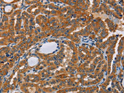 The image on the left is immunohistochemistry of paraffin-embedded Human thyroid cancer tissue using CSB-PA441632(KRT13 Antibody) at dilution 1/50, on the right is treated with fusion protein. (Original magnification: ×200)
