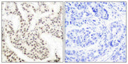 Immunohistochemical analysis of paraffin-embedded human breast carcinoma tissue using Elk-1 (phospho-Thr417) antibody.