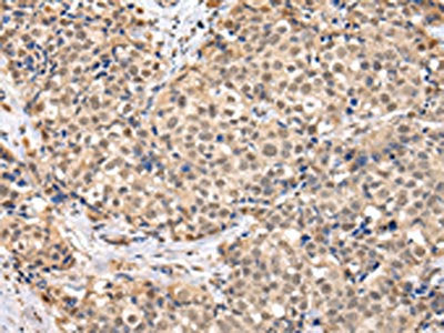 The image on the left is immunohistochemistry of paraffin-embedded Human breast cancer tissue using CSB-PA441798(TBL1X Antibody) at dilution 1/30, on the right is treated with fusion protein. (Original magnification: ×200)
