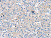 The image on the left is immunohistochemistry of paraffin-embedded Human liver cancer tissue using CSB-PA441852(PTX3 Antibody) at dilution 1/25, on the right is treated with synthetic peptide. (Original magnification: ×200)