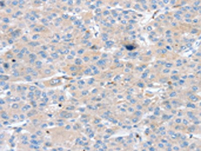 The image on the left is immunohistochemistry of paraffin-embedded Human liver cancer tissue using CSB-PA441852(PTX3 Antibody) at dilution 1/25, on the right is treated with synthetic peptide. (Original magnification: ×200)