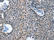 The image on the left is immunohistochemistry of paraffin-embedded Human lung cancer tissue using CSB-PA442042(CAGE1 Antibody) at dilution 1/15, on the right is treated with synthetic peptide. (Original magnification: ×200)