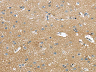 The image on the left is immunohistochemistry of paraffin-embedded Human brain tissue using CSB-PA442448(WASF2 Antibody) at dilution 1/25, on the right is treated with synthetic peptide. (Original magnification: ×200)
