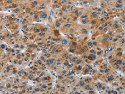 The image on the left is immunohistochemistry of paraffin-embedded Human liver cancer tissue using CSB-PA442564(IAPP Antibody) at dilution 1/40, on the right is treated with synthetic peptide. (Original magnification: ×200)