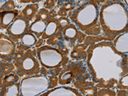The image on the left is immunohistochemistry of paraffin-embedded Human thyroid cancer tissue using CSB-PA442571(PARL Antibody) at dilution 1/25, on the right is treated with fusion protein. (Original magnification: ×200)