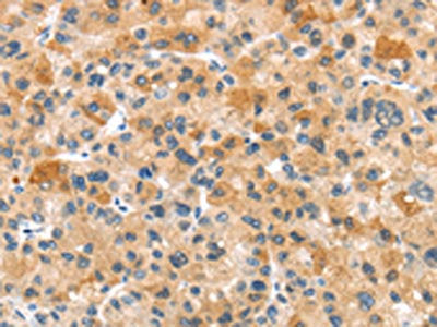 The image on the left is immunohistochemistry of paraffin-embedded Human liver cancer tissue using CSB-PA442653(RHCG Antibody) at dilution 1/35, on the right is treated with synthetic peptide. (Original magnification: ×200)
