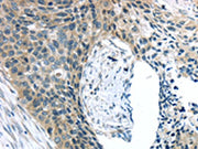 The image on the left is immunohistochemistry of paraffin-embedded Human esophagus cancer tissue using CSB-PA442757(KIT Antibody) at dilution 1/25, on the right is treated with synthetic peptide. (Original magnification: ×200)