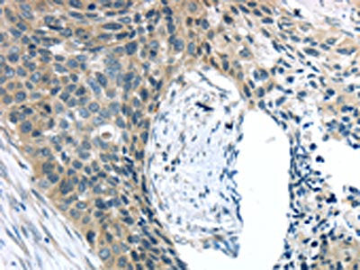 The image on the left is immunohistochemistry of paraffin-embedded Human esophagus cancer tissue using CSB-PA442757(KIT Antibody) at dilution 1/25, on the right is treated with synthetic peptide. (Original magnification: ×200)