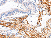 The image on the left is immunohistochemistry of paraffin-embedded Human colon cancer tissue using CSB-PA442774(ARAP1 Antibody) at dilution 1/80, on the right is treated with synthetic peptide. (Original magnification: ×200)