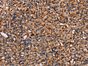 The image on the left is immunohistochemistry of paraffin-embedded Human prostate cancer tissue using CSB-PA443057(PLXNA1 Antibody) at dilution 1/30, on the right is treated with synthetic peptide. (Original magnification: ×200)