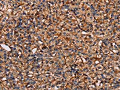 The image on the left is immunohistochemistry of paraffin-embedded Human prostate cancer tissue using CSB-PA443057(PLXNA1 Antibody) at dilution 1/30, on the right is treated with synthetic peptide. (Original magnification: ×200)