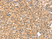 The image on the left is immunohistochemistry of paraffin-embedded Human prostate cancer tissue using CSB-PA443443(SLC43A2 Antibody) at dilution 1/20, on the right is treated with synthetic peptide. (Original magnification: ×200)