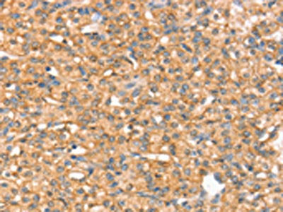The image on the left is immunohistochemistry of paraffin-embedded Human prostate cancer tissue using CSB-PA443443(SLC43A2 Antibody) at dilution 1/20, on the right is treated with synthetic peptide. (Original magnification: ×200)
