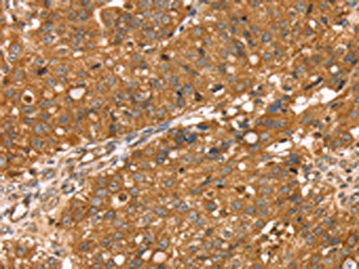The image on the left is immunohistochemistry of paraffin-embedded Human breast cancer tissue using CSB-PA443565(RNASET2 Antibody) at dilution 1/30, on the right is treated with fusion protein. (Original magnification: ×200)