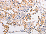 The image on the left is immunohistochemistry of paraffin-embedded Human thyroid cancer tissue using CSB-PA443599(MYLK3 Antibody) at dilution 1/30, on the right is treated with fusion protein. (Original magnification: ×200)