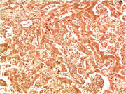 Immunohistochemical analysis of paraffin-embedded Human Hepatocarcinoma Tissue using ATG7 Rabbit pAb diluted at 1:200