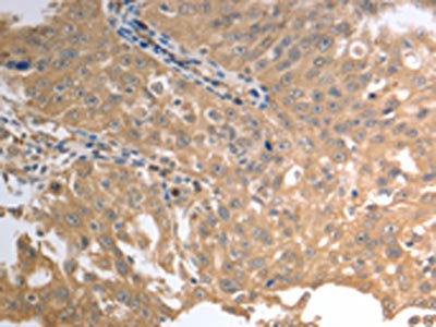 The image on the left is immunohistochemistry of paraffin-embedded Human ovarian cancer tissue using CSB-PA443704(SLC1A4 Antibody) at dilution 1/70, on the right is treated with synthetic peptide. (Original magnification: ×200)