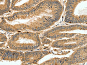 The image on the left is immunohistochemistry of paraffin-embedded Human colon cancer tissue using CSB-PA443727(S100A4 Antibody) at dilution 1/80, on the right is treated with synthetic peptide. (Original magnification: ×200)