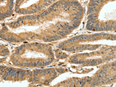 The image on the left is immunohistochemistry of paraffin-embedded Human colon cancer tissue using CSB-PA443727(S100A4 Antibody) at dilution 1/80, on the right is treated with synthetic peptide. (Original magnification: ×200)
