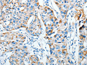 The image on the left is immunohistochemistry of paraffin-embedded Human breast cancer tissue using CSB-PA443866(AGA Antibody) at dilution 1/20, on the right is treated with fusion protein. (Original magnification: ×200)