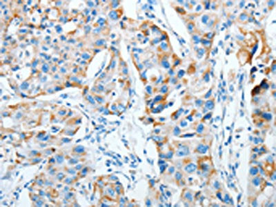 The image on the left is immunohistochemistry of paraffin-embedded Human breast cancer tissue using CSB-PA443866(AGA Antibody) at dilution 1/20, on the right is treated with fusion protein. (Original magnification: ×200)