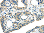 The image on the left is immunohistochemistry of paraffin-embedded Human thyroid cancer tissue using CSB-PA443873(WNK3 Antibody) at dilution 1/20, on the right is treated with synthetic peptide. (Original magnification: ×200)