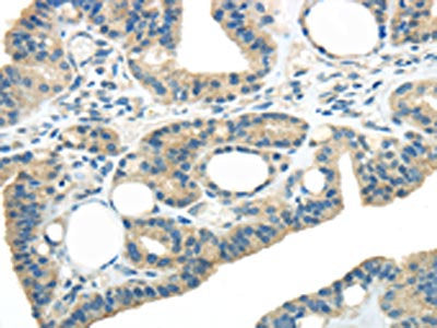 The image on the left is immunohistochemistry of paraffin-embedded Human thyroid cancer tissue using CSB-PA443873(WNK3 Antibody) at dilution 1/20, on the right is treated with synthetic peptide. (Original magnification: ×200)