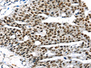 The image on the left is immunohistochemistry of paraffin-embedded Human breast cancer tissue using CSB-PA444135(RRAS Antibody) at dilution 1/25, on the right is treated with synthetic peptide. (Original magnification: ×200)