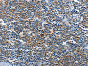 The image on the left is immunohistochemistry of paraffin-embedded Human lymphoma tissue using CSB-PA444209(NEK1 Antibody) at dilution 1/25, on the right is treated with synthetic peptide. (Original magnification: ×200)