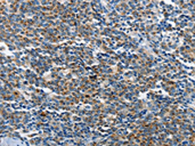 The image on the left is immunohistochemistry of paraffin-embedded Human lymphoma tissue using CSB-PA444209(NEK1 Antibody) at dilution 1/25, on the right is treated with synthetic peptide. (Original magnification: ×200)