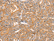 The image on the left is immunohistochemistry of paraffin-embedded Human thyroid cancer tissue using CSB-PA444301(SLC16A8 Antibody) at dilution 1/40, on the right is treated with synthetic peptide. (Original magnification: ×200)