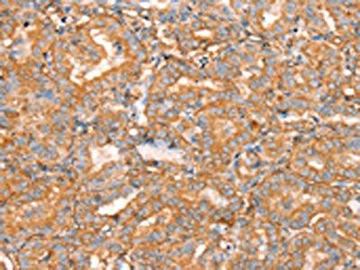 The image on the left is immunohistochemistry of paraffin-embedded Human thyroid cancer tissue using CSB-PA444301(SLC16A8 Antibody) at dilution 1/40, on the right is treated with synthetic peptide. (Original magnification: ×200)