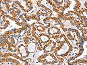 The image on the left is immunohistochemistry of paraffin-embedded Human thyroid cancer tissue using CSB-PA444394(AIFM3 Antibody) at dilution 1/40, on the right is treated with fusion protein. (Original magnification: ×200)