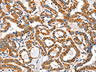 The image on the left is immunohistochemistry of paraffin-embedded Human thyroid cancer tissue using CSB-PA444394(AIFM3 Antibody) at dilution 1/40, on the right is treated with fusion protein. (Original magnification: ×200)